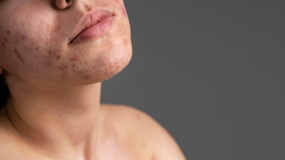 mujer joven piel atopica