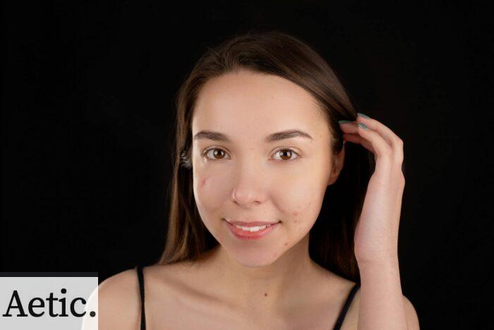crema facial acné